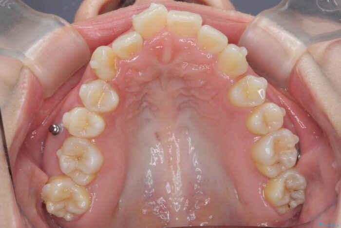 サクソフォンによる影響をマウスピース矯正で整える 治療途中画像