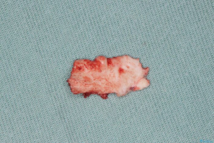 静脈内鎮静を併用した骨隆起の切除 治療途中画像