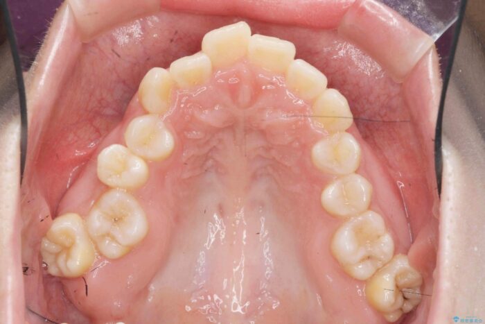 サクソフォンによる影響をマウスピース矯正で整える 治療前画像