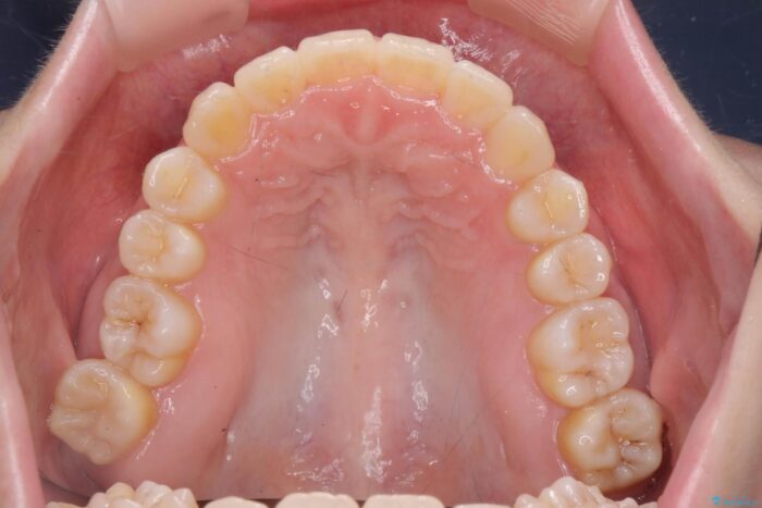 サクソフォンによる影響をマウスピース矯正で整える 治療後画像