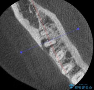 歯茎の腫れが収まらず相談 治療途中画像