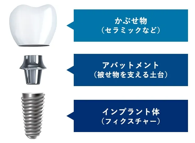 インプラント