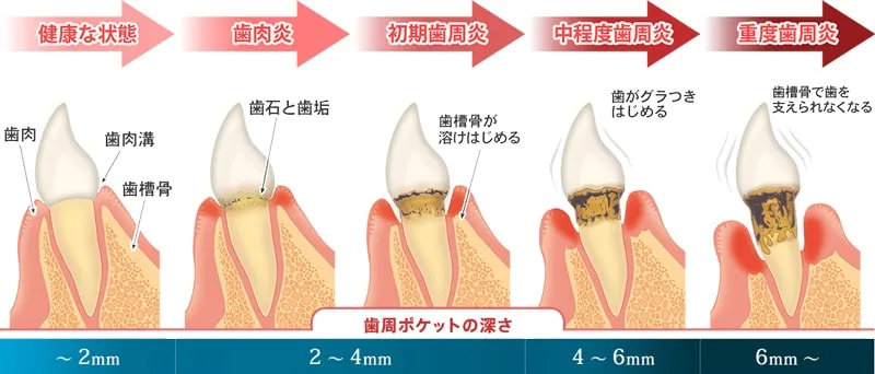 歯周病の進行過程