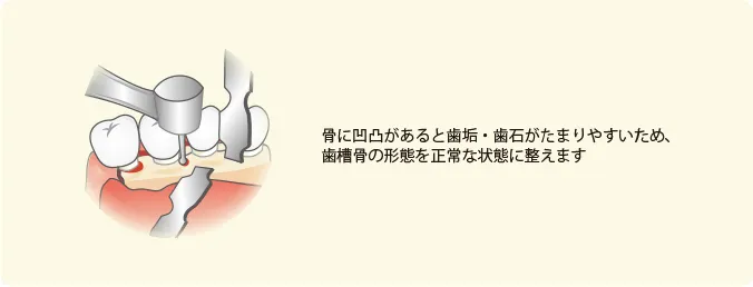 歯槽骨整形術