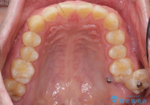 インビザラン、部分矯正併用しがたつきの改善 治療途中画像