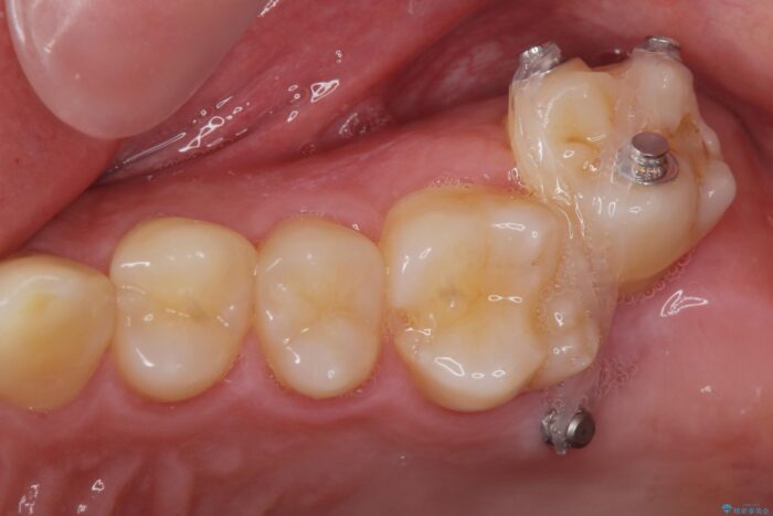 インビザラン、部分矯正併用しがたつきの改善 治療途中画像