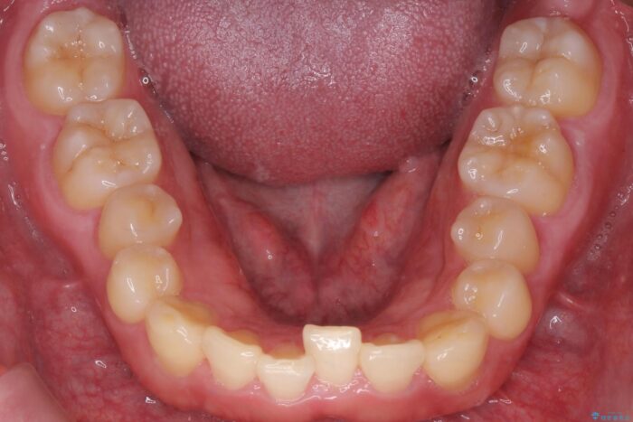 インビザラン、部分矯正併用しがたつきの改善 治療前画像
