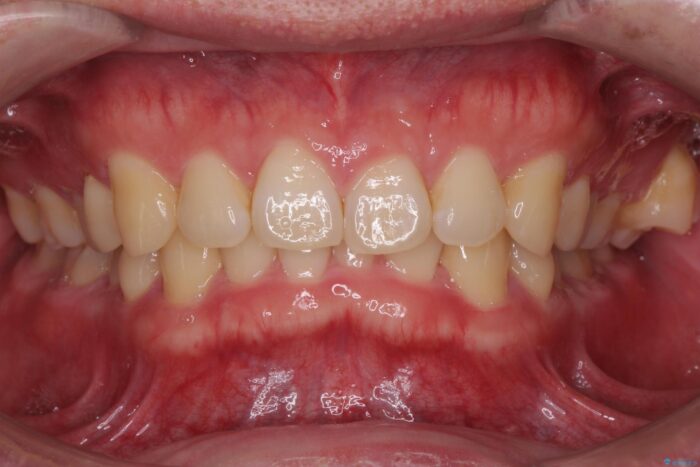 インビザラン、部分矯正併用しがたつきの改善 治療前画像