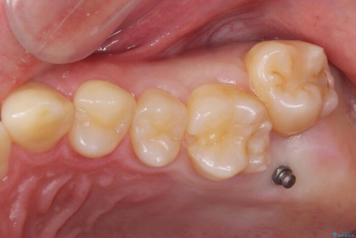 インビザラン、部分矯正併用しがたつきの改善 治療前画像
