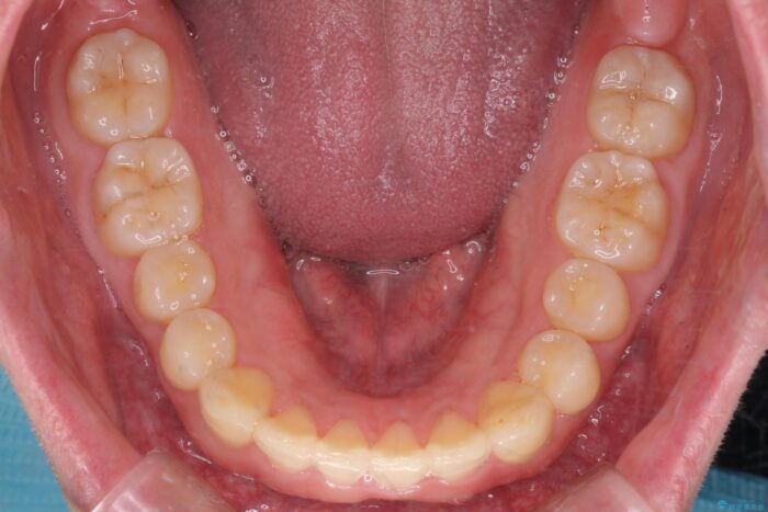 インビザラン、部分矯正併用しがたつきの改善 治療後画像