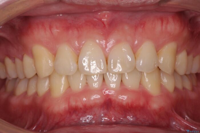 インビザラン、部分矯正併用しがたつきの改善 治療後画像