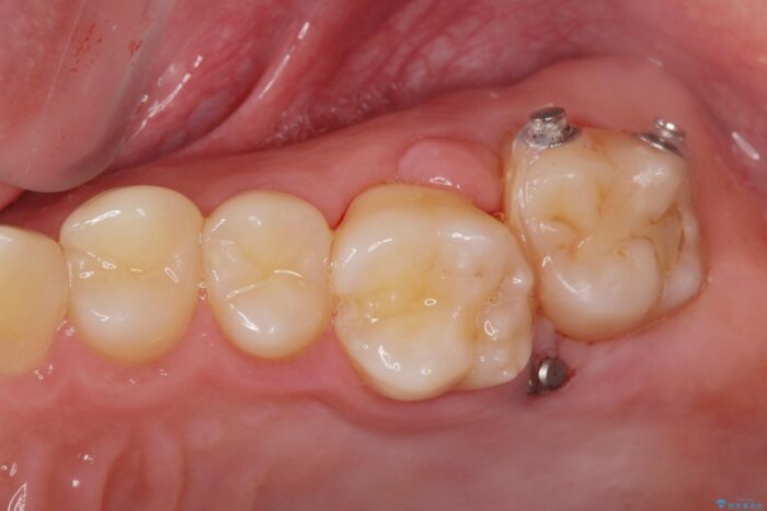インビザラン、部分矯正併用しがたつきの改善 治療後画像