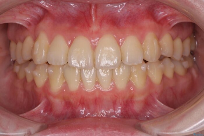 前歯のねじれを解消！矯正治療で見た目の印象を格上げ 治療途中画像