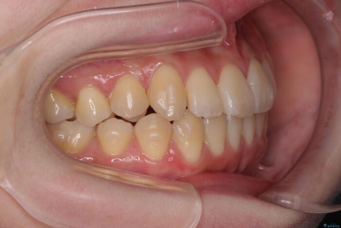 前歯のねじれを解消！矯正治療で見た目の印象を格上げ 治療途中画像