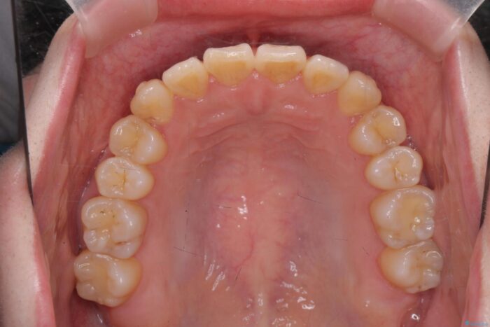 前歯のねじれを解消！矯正治療で見た目の印象を格上げ 治療途中画像