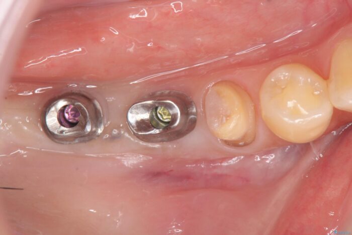 しっかり噛めない奥歯、インプラント治療で改善 治療途中画像
