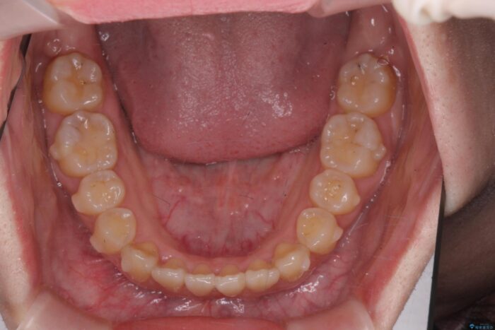 前歯のねじれを解消！矯正治療で見た目の印象を格上げ 治療途中画像