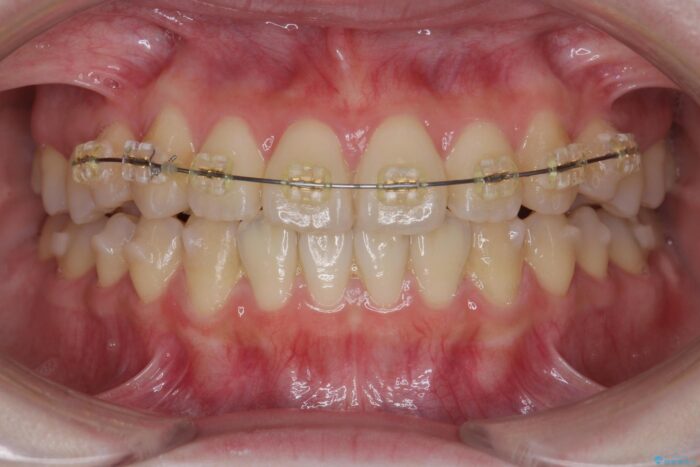 前歯のねじれを解消！矯正治療で見た目の印象を格上げ 治療途中画像