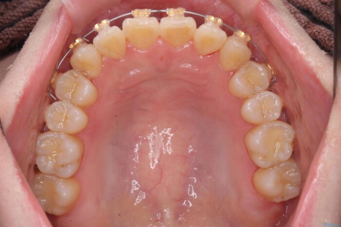 前歯のねじれを解消！矯正治療で見た目の印象を格上げ 治療途中画像