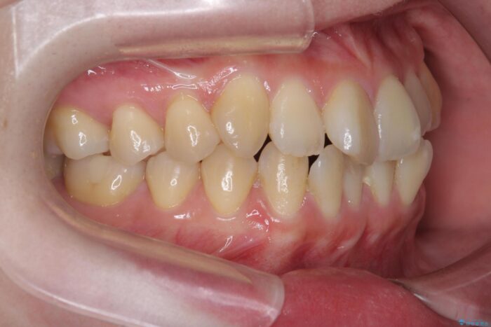 前歯のねじれを解消！矯正治療で見た目の印象を格上げ 治療前画像