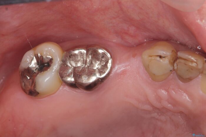 しっかり噛めない奥歯、インプラント治療で改善 治療前画像
