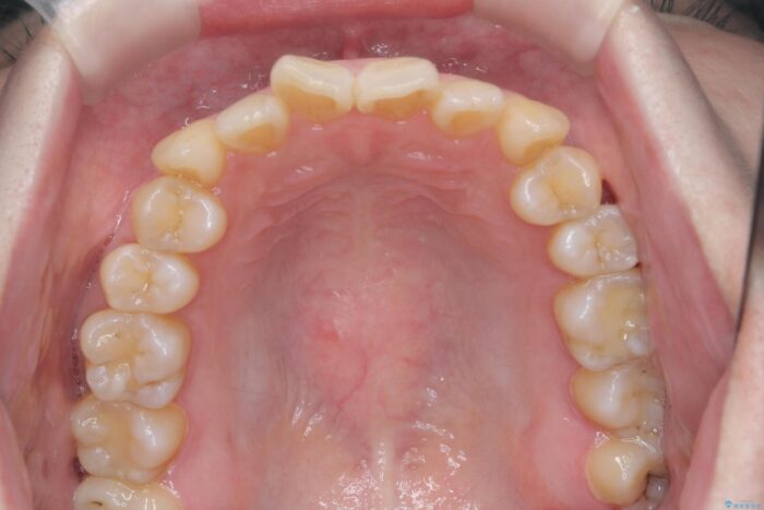 前歯のねじれを解消！矯正治療で見た目の印象を格上げ 治療前画像