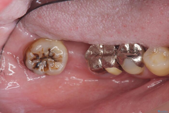 しっかり噛めない奥歯、インプラント治療で改善 治療前画像