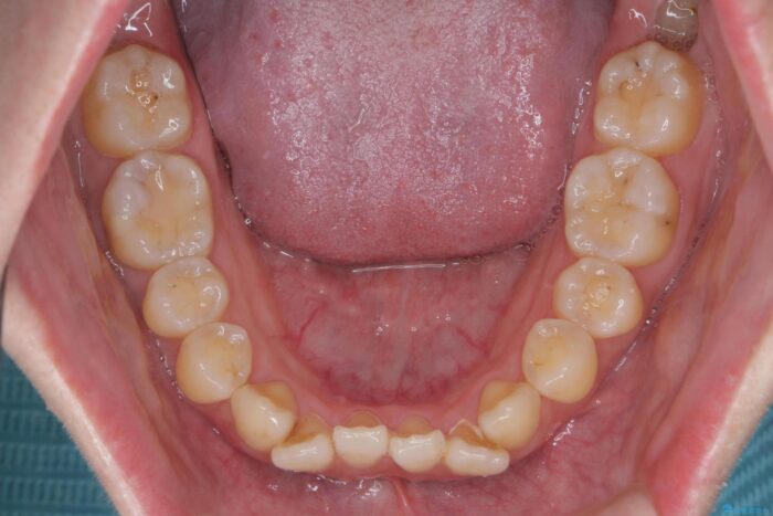 前歯のねじれを解消！矯正治療で見た目の印象を格上げ 治療前画像