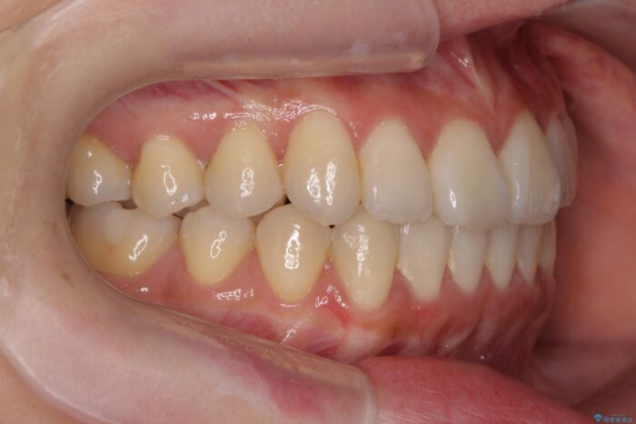 前歯のねじれを解消！矯正治療で見た目の印象を格上げ 治療後画像