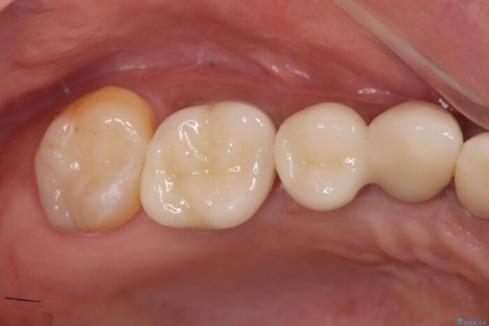 しっかり噛めない奥歯、インプラント治療で改善 治療後画像