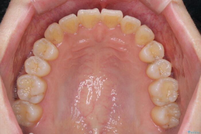 前歯のねじれを解消！矯正治療で見た目の印象を格上げ 治療後画像