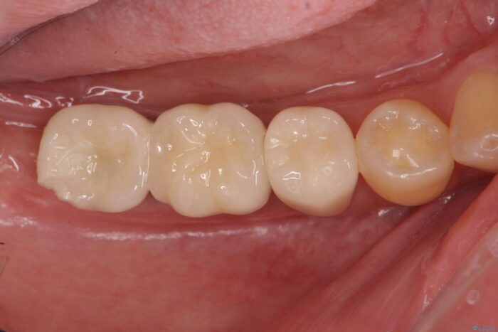 しっかり噛めない奥歯、インプラント治療で改善 治療後画像