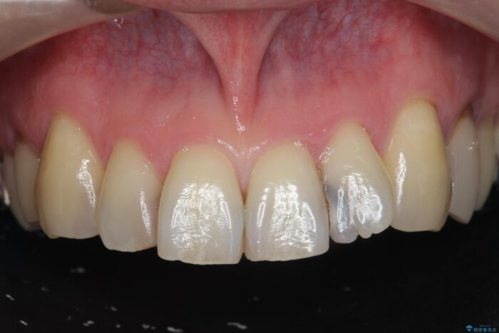 前歯の歯間の虫歯、セラミックで美しく ビフォー