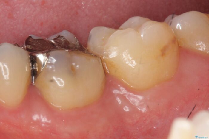 適合の悪い銀歯をセラミックへ ビフォー