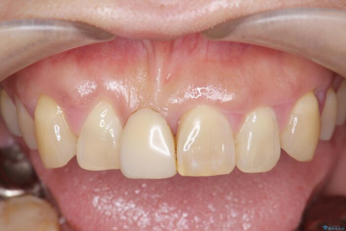 中等度歯周病の治療後にセラミックで美しい前歯に ビフォー