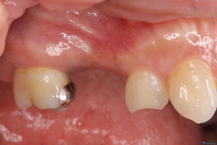 虫歯で失った奥歯、インプラント治療で咬合機能の回復 ビフォー
