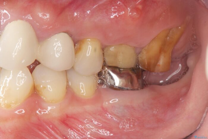 清掃しやすいクラウンへ ビフォー