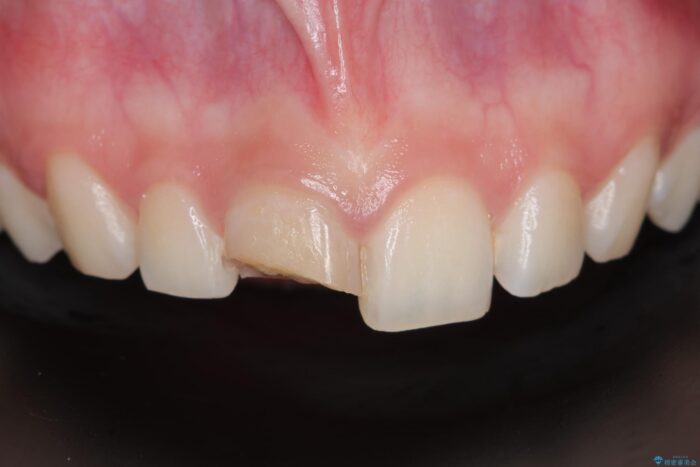 欠けた前歯、根管治療からやり直す ビフォー