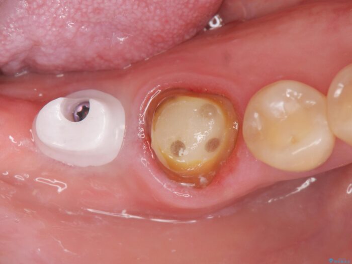 インプラント治療で咬合機能を回復 治療途中画像