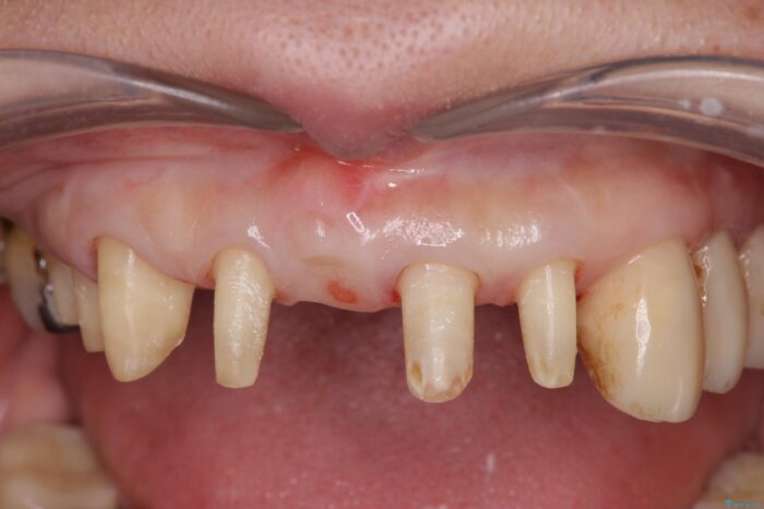 中等度歯周病の治療後にセラミックで美しい前歯に 治療途中画像