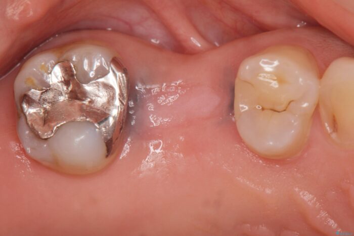 虫歯で失った奥歯、インプラント治療で咬合機能の回復 治療途中画像