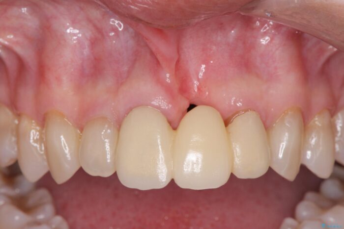 歯ぐきのボリュームを回復しブリッジで自然で美しい歯に 治療途中画像