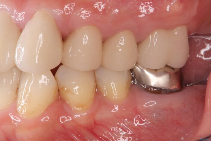 清掃しやすいクラウンへ 治療後画像