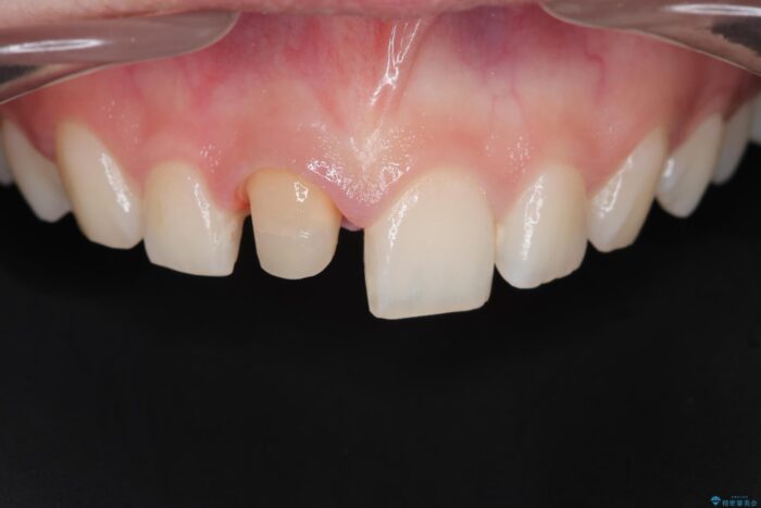 欠けた前歯、根管治療からやり直す 治療途中画像