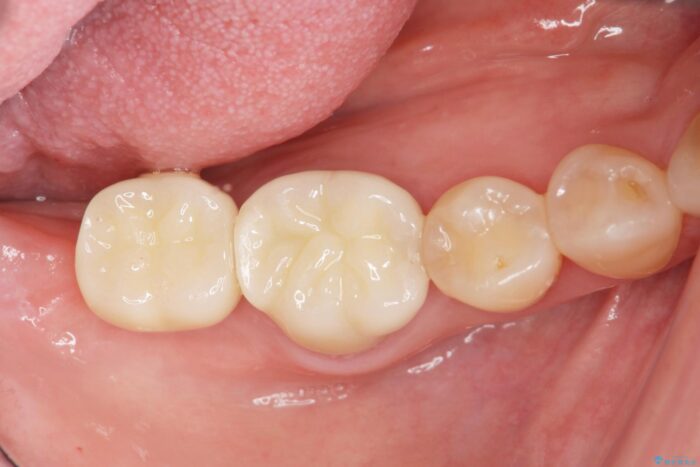 インプラント治療で咬合機能を回復 治療後画像