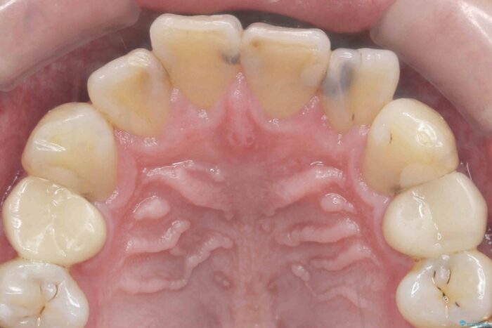 前歯の歯間の虫歯、セラミックで美しく 治療前画像