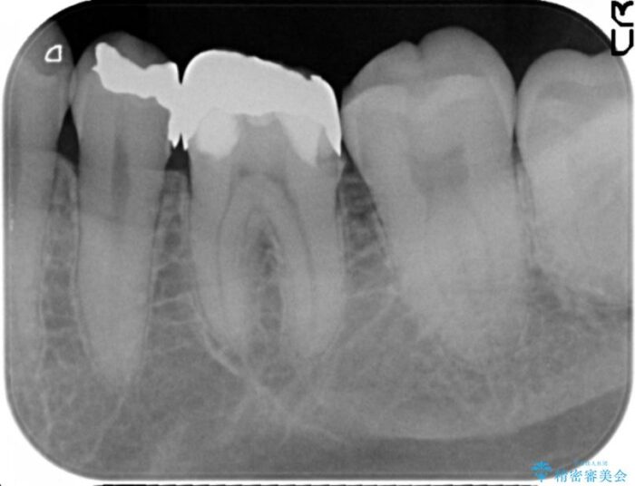 適合の悪い銀歯をセラミックへ 治療前画像