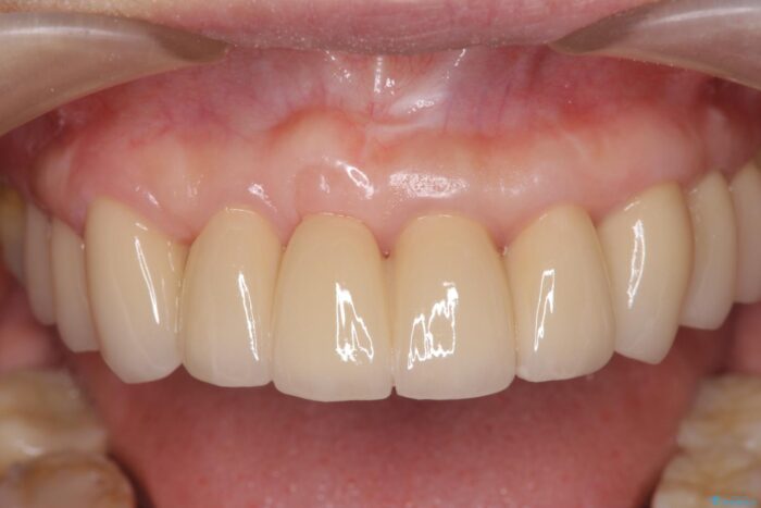 中等度歯周病の治療後にセラミックで美しい前歯に 治療後画像