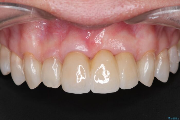 歯ぐきのボリュームを回復しブリッジで自然で美しい歯に 治療後画像