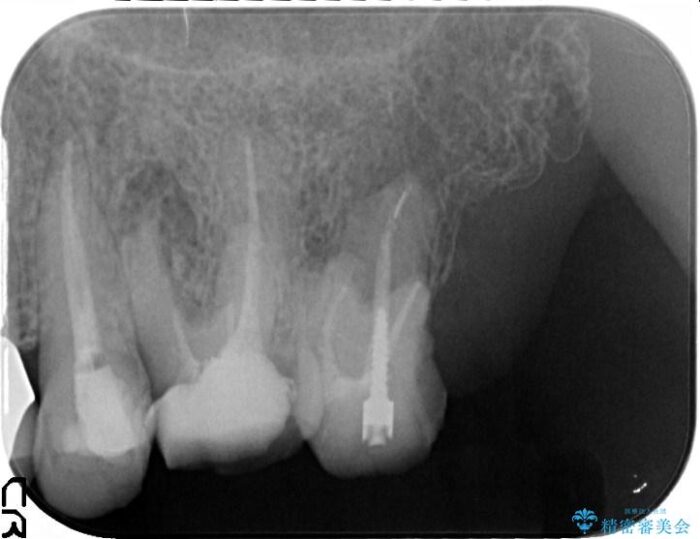 清掃しやすいクラウンへ 治療前画像